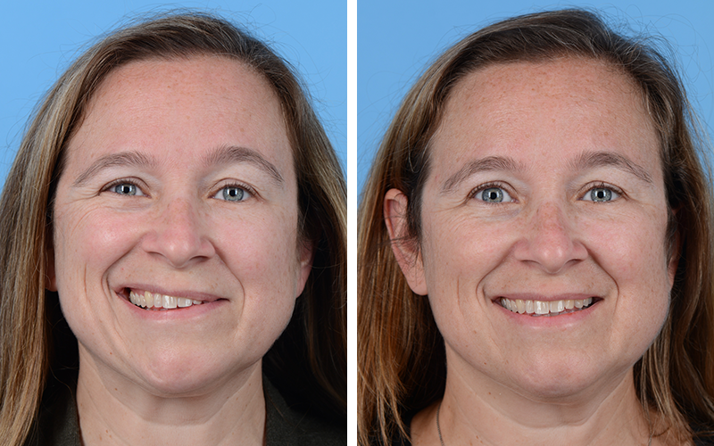 before and after photos of a patient with facial paralysis