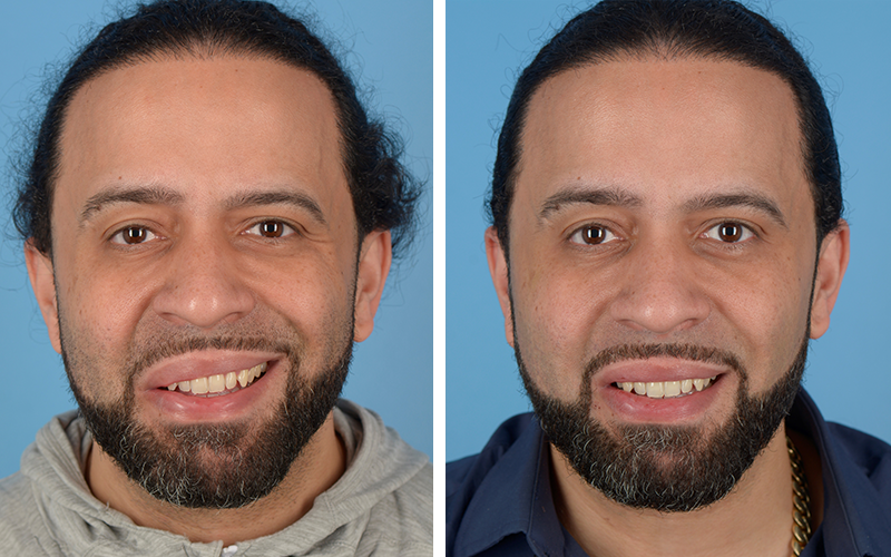 before and after photo of a patient with synkenesis